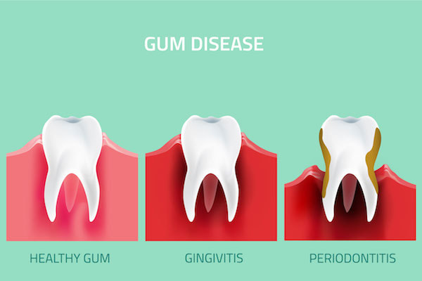 Gingivitis, periodontal disease, health teeth